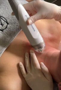 RF Microneedling EndyMed