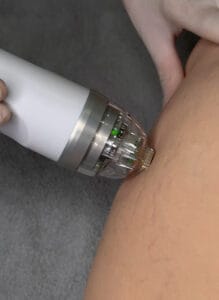 RF Microneedling EndyMed